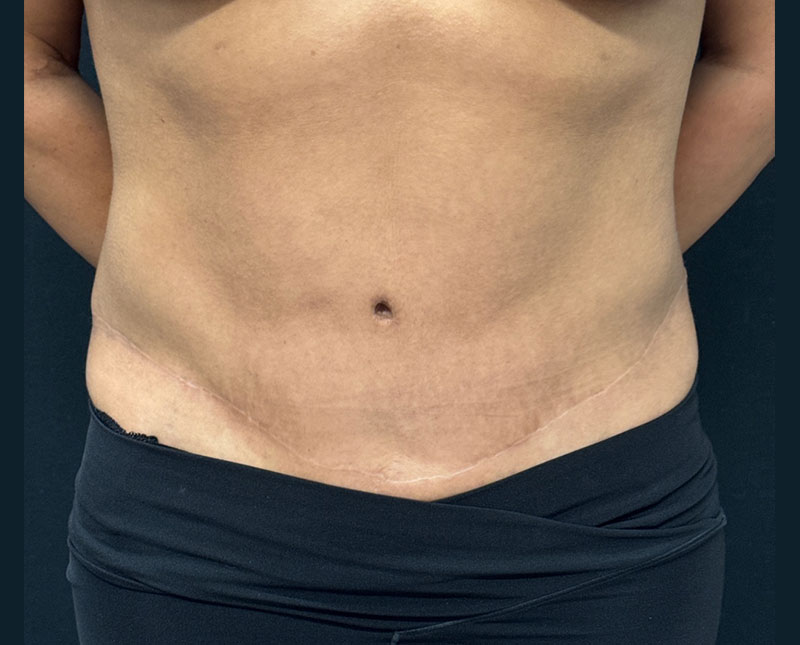 39 year old female 1 year after abdominoplasty and liposuction
